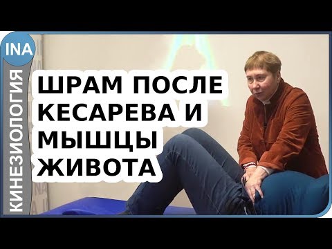 Видео: Влияние шрама от кесарево на мышцы живота. Как убрать живот? Васильева кинезиоология