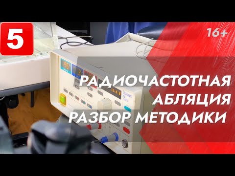 Видео: Выпуск 5. Просто о сложном: Радиочастотная абляция: как это работает? Почему пациент в сознании?