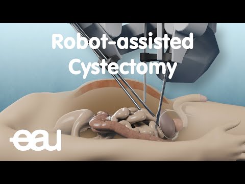 Видео: Роботизированная цистэктомия