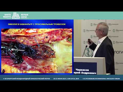 Видео: Коррекция венозных тромбоэмболических осложнений у онкологических больных (Черкасов В.А.)