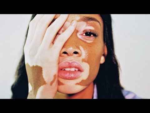 Видео: ВИТИЛИГО: Современные представления о патогенезе и лечении