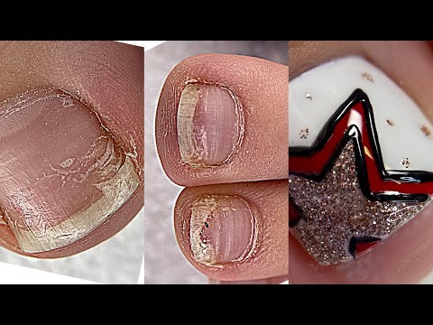 Видео: Педикюр на себе💅 Раскрываю секреты😍 Опять подногтевая мозоль