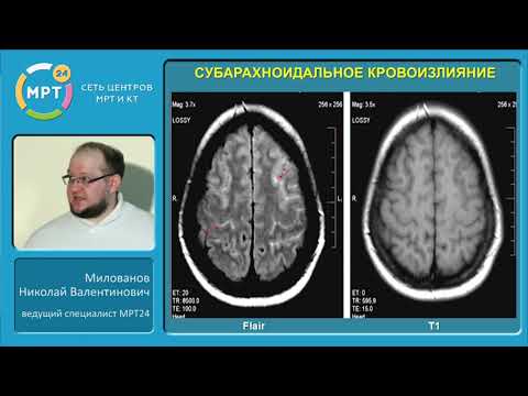 Видео: «МРТ в диагностике острых нарушений мозгового кровообращения по ишемическому типу»