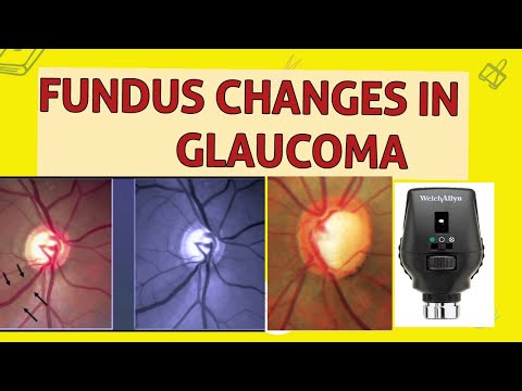 Видео: ИЗМЕНЕНИЯ ДИСКА ЗРИТЕЛЬНОГО НЕРА ПРИ ГЛАУКОМЕ