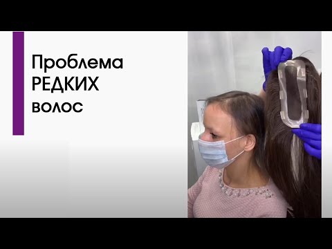 Видео: РЕДКИЕ ВОЛОСЫ? ОБЛЫСЕНИЕ?