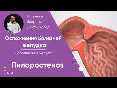 Видео: Пилоростеноз - осложнения болезни желудка
