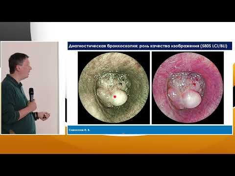 Видео: 4. Сивокозов ИВ Бронхоскопия высокой четкости - современные возможности.