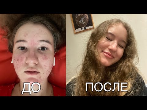 Видео: ЛЕЧЕНИЕ АКНЕ: моя история, прием системных ретиноидов, сотрет, советы, результат до и после 💊🧴
