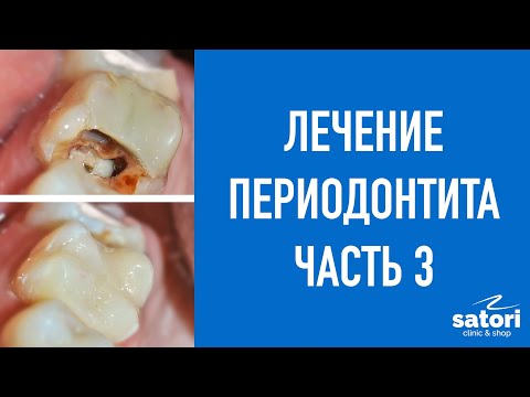Видео: Лечение периодонтита часть 3. Восстановление зуба на штифте.