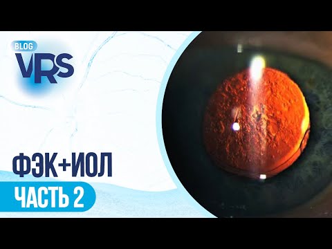 Видео: Хирургия катаракты / Задний капсулорексис vs лазерная дисцизия