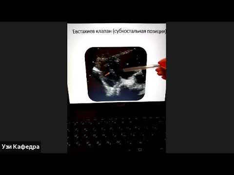 Видео: УЗИ Правых отделов сердца Малыхина Е С