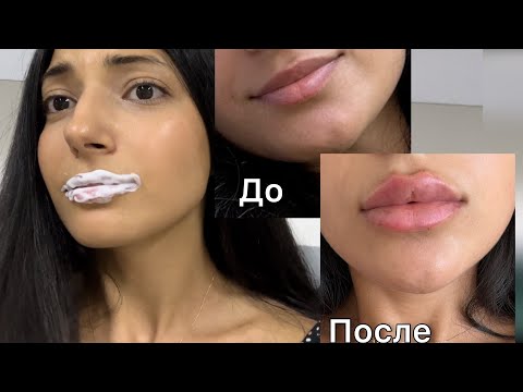 Видео: Сделала губы первый раз / Больно или нет ? Препарат Stylage M #сделалагубы