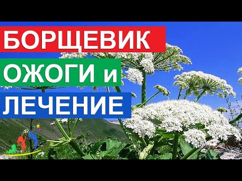 Видео: Борщевик Сосновского ожоги и лечение. Первая помощь, если Вы коснулись это ядовитое растение.