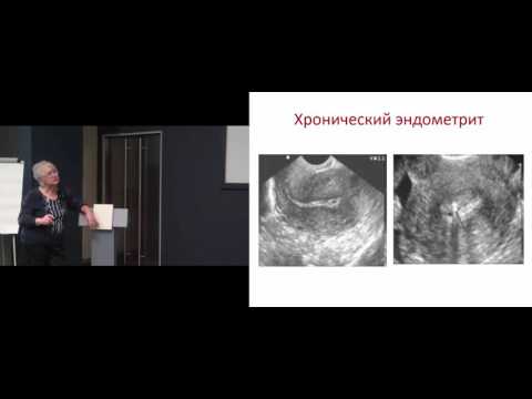 Видео: Хронический эндометрит  | Диагностика, лечение и профилактика | Мальцева Лариса Ивановна