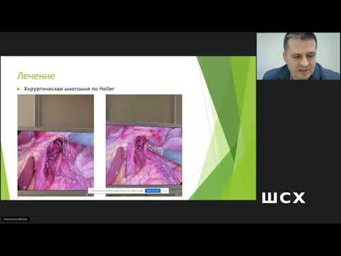 Видео: Давыдов В. Современные подходы к лечению ахалазии