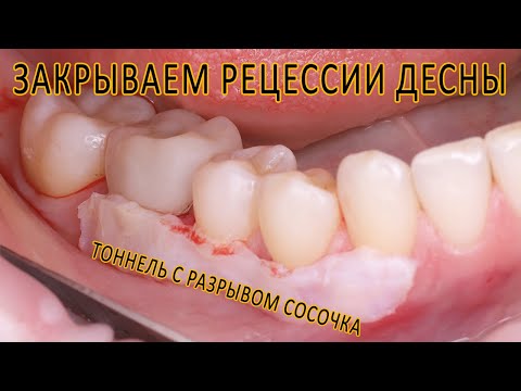 Видео: Хирургическое закрытие рецессий десны с разрывом десневого сосочка