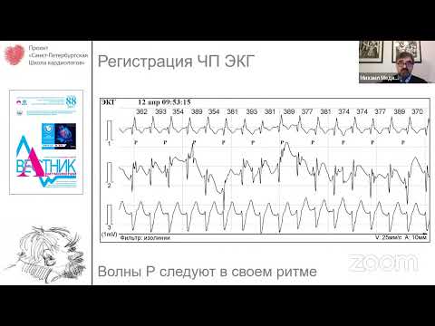 Видео: Современные подходы к определению генеза «широких комплексов» QRS при электронной регистрации ЭКС