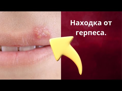 Видео: Герпес на губах больше не проблема с этим простым решением!