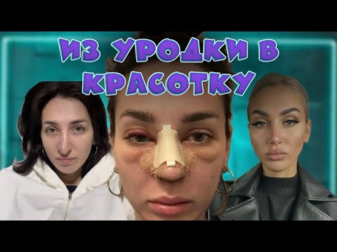 Видео: МОЯ РИНОПЛАСТИКА / Стала Красивой За 7 Дней / 7 Дней В Стамбуле