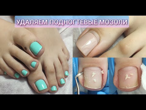 Видео: ОГРОМНЫЕ ПОДНОГТЕВЫЕ МОЗОЛИ😱Как убрать подногтевую мозоль подробно😑Почему болят ногти на ногах?  腳趾甲
