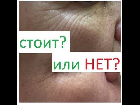 Видео: Мезотерапия вокруг глаз от от мешков и морщин под глазами. Как выбрать? Чего опасаться?
