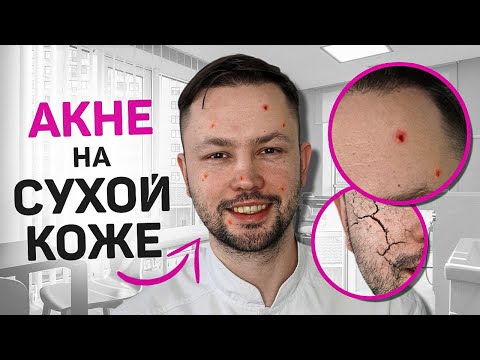 Видео: Почему АКНЕ на сухой коже? Что делать? Ответ врача