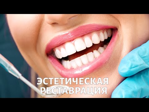 Видео: Что такое эстетическая РЕСТАВРАЦИЯ ЗУБОВ?