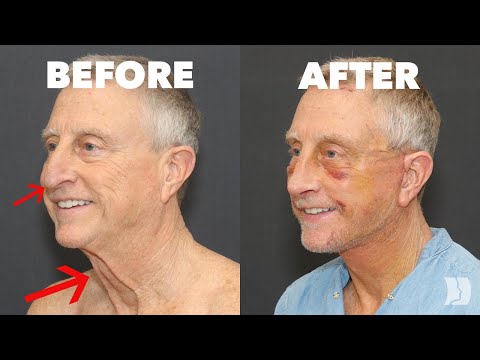 Видео: 70-летние мужчины тоже делают подтяжку лица — и выглядят потрясающе
