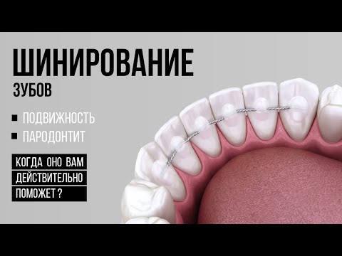 Видео: Шатаются зубы. Поможет ли шинирование❓