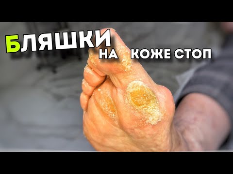 Видео: Кожные уплотнения в виде бляшек под большим пальцем. Способы удаления #подологтатьянапак