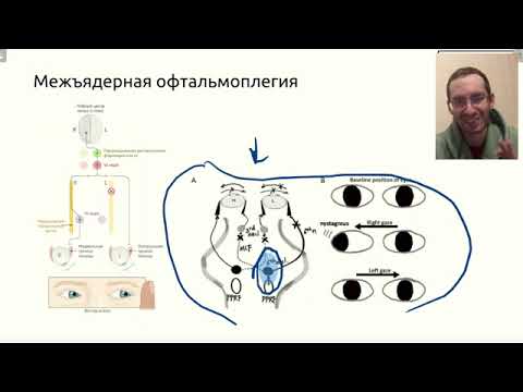 Видео: Содружественное движение глаз  Межъядерная офтальмоплегия