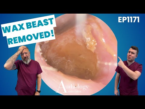 Видео: Глубокое удаление ушной серы с обширным пилингом кожи! - EP1171