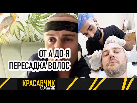 Видео: Пересадка волос в Турции от А до Я: Это больно? Есть ли эффект? Испытываю на себе / Красавчик