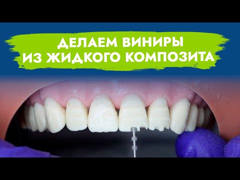 Видео: Композитные виниры. Прямая методика изготовления при помощи жидкого композита.
