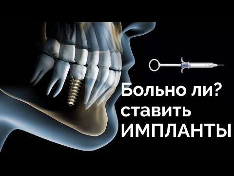 Видео: Больно ли ставить имплант. Анестезия. Ход процедуры.