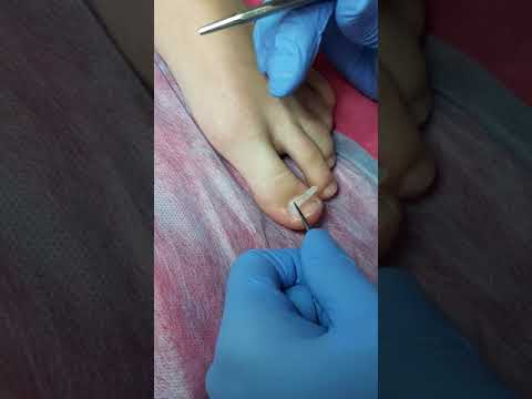 Видео: Установка BS-пластины (видео 2) - Эстетико-подологический центр Елены Басковой