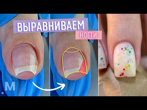 Видео: Коррекция ДЕФОРМИРОВАННЫХ ногтей. Исправляем СКРУЧИВАЮЩИЕСЯ и КЛЮЮЩИЕ ногти. Модный маникюр