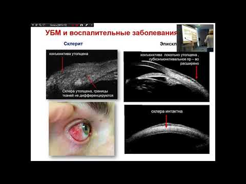 Видео: «Современные ультразвуковые исследования в офтальмологии»