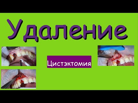 Видео: Удаление. Цистэктомия.