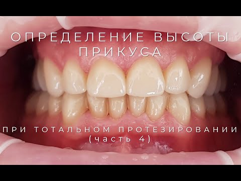 Видео: Определение Высота Прикуса при тотальном Протезировании  часть 4