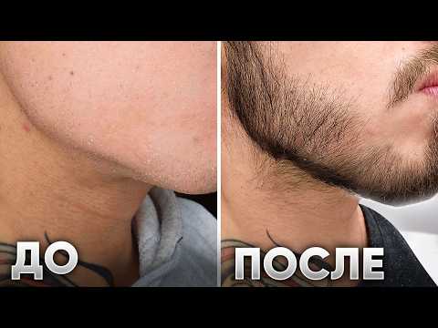 Видео: От гладких щёк до густой бороды за 3 месяца! Результат применения Mr.Volos 5%