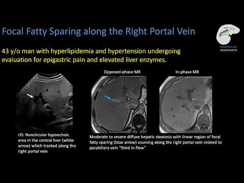 Видео: Стеатоз печени. Часть 3: Имитации и подводные камни