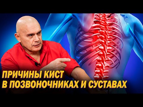 Видео: Что такое гемангиома позвоночника? Кисты в суставах и позвонках: причины и лечение