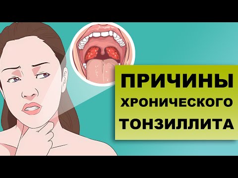 Видео: ПРИЧИНЫ ХРОНИЧЕСКОГО ТОНЗИЛЛИТА