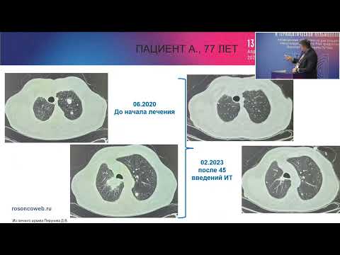 Видео: Сложный клинический случай лечения рака легкого