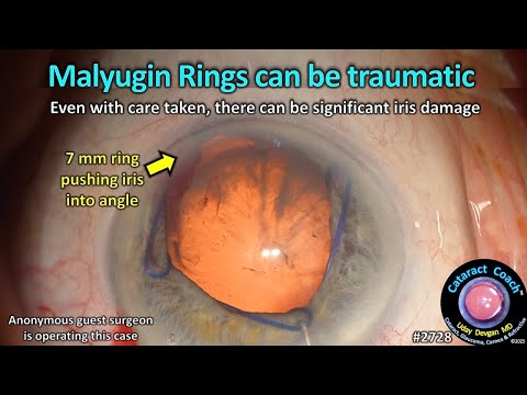 Видео: CataractCoach™ 2728: Кольца Малюгина могут травмировать радужную оболочку