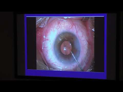 Видео: Замена помутневшей ИОЛ