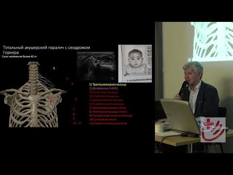 Видео: Совместное использование ЭМГ и УЗИ. Семинар Дружинина Д.С. д.м.н. Москва 15 июля 23г. часть 3/3