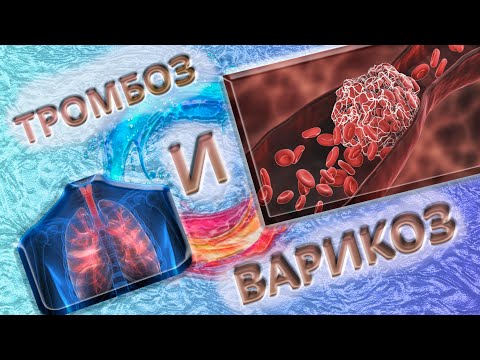 Видео: Тромбофлебит и тромбоз вен при варикозе