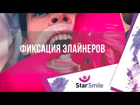 Видео: Впервые делаешь это!? Что нужно знать о первичной фиксации элайнеров? #starsmile #безбрекетов